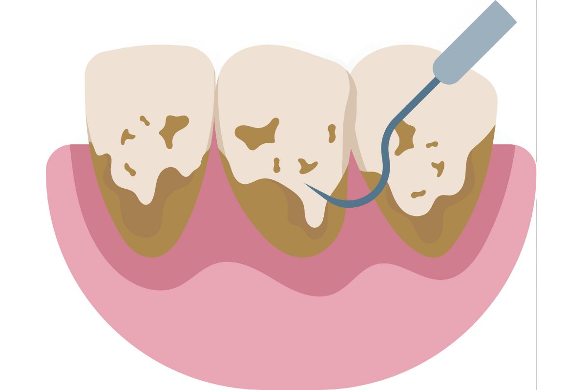 Ein illustriertes Bild eines Zahns mit schwarzen Zahnsteinablagerungen auf dem Zahnfleisch