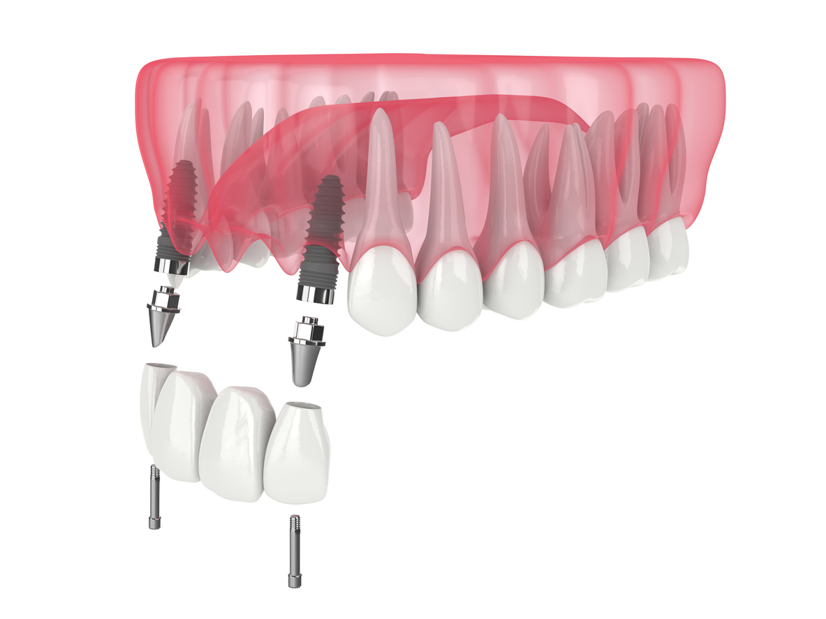 3D-Darstellung des Kiefers mit Zahnschneidezahnbrücke, unterstützt durch Implantate auf weißem Hintergrund