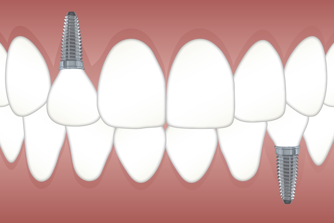 illustrierte Zeichnung eines Zahns, bei dem das zahnImplantat verdreht ist