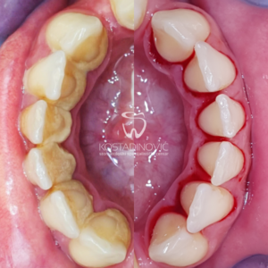 Foto der Zähne vor und nach der Zahnsteinentfernungstherapie, auf dem etwas Blut zu sehen ist, was nach einer Reizung ein völlig normales Phänomen ist