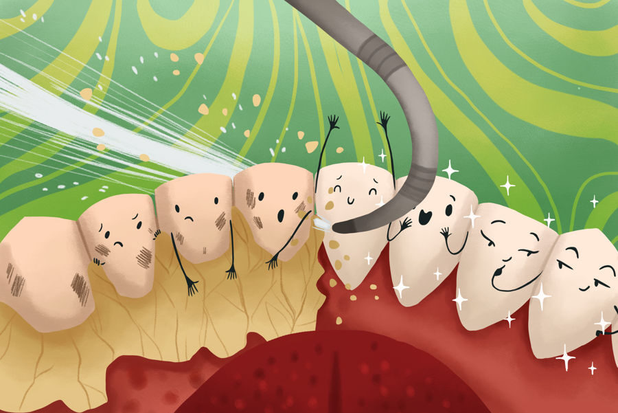 Sve što trebate znati o zubnom kamencu