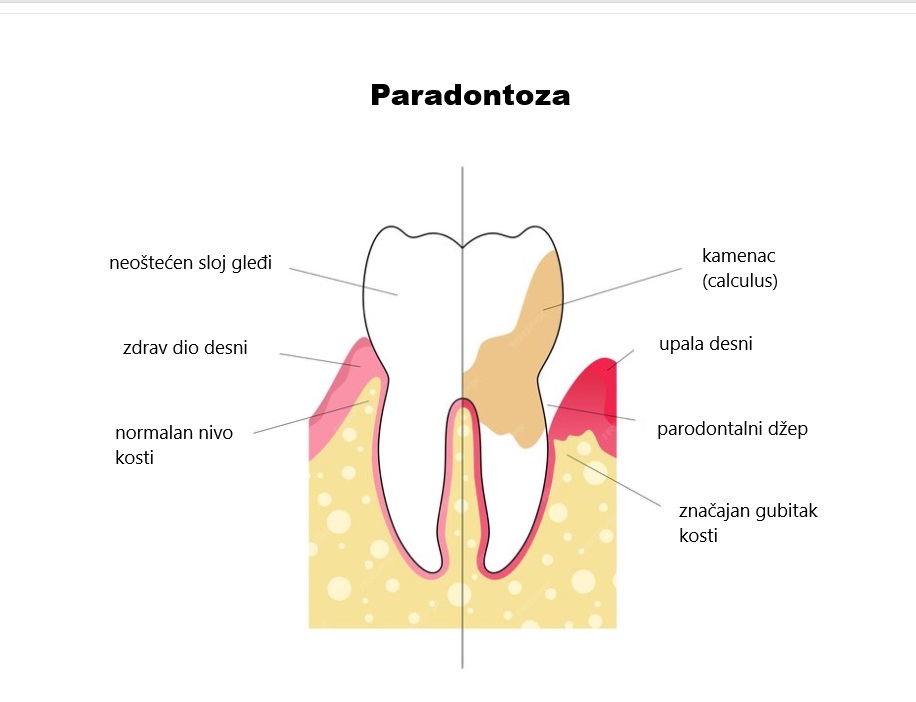 Prikaz poređenja zdravog zuba i kako izgleda kada je pristuna paradontoza