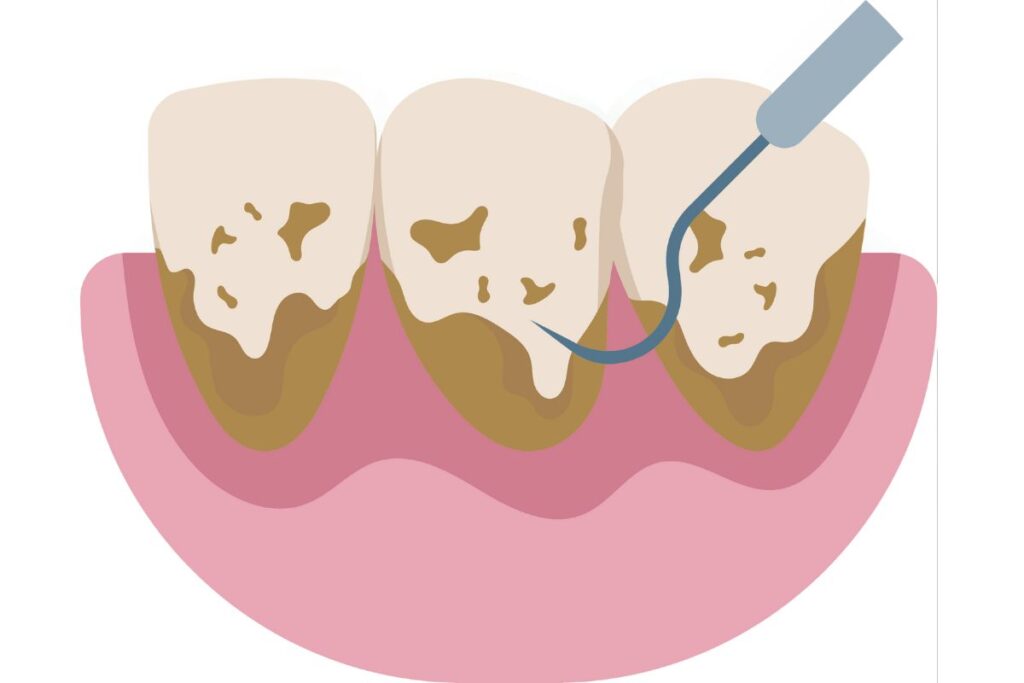 Illustration von schwarzem Zahnstein auf den Zähnen, sichtbar entlang des Zahnfleischrandes.