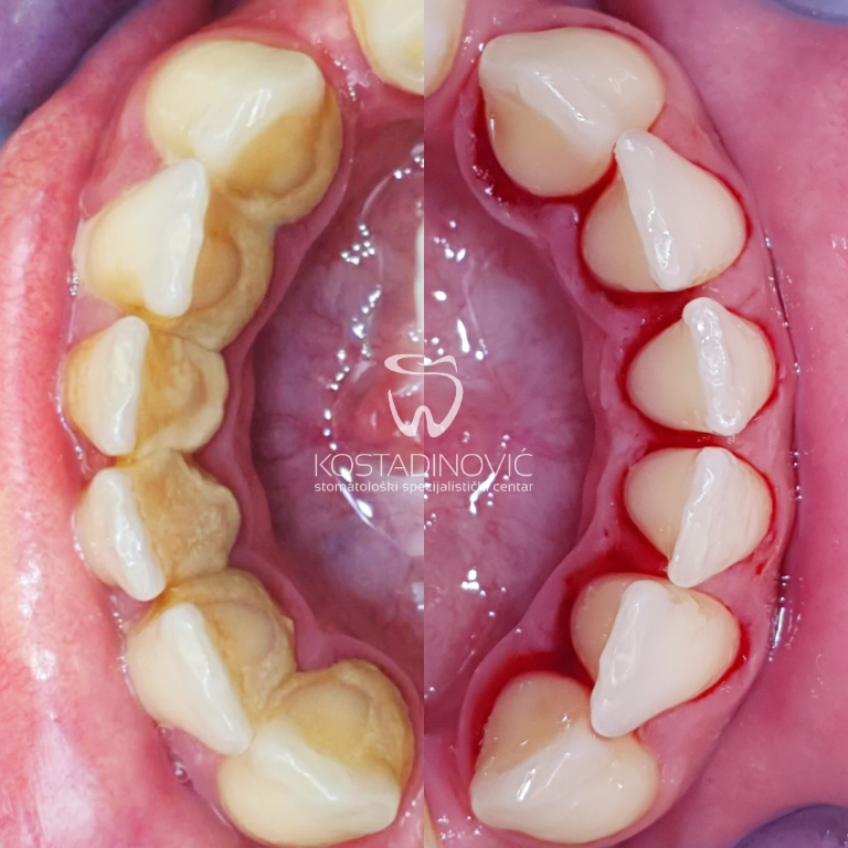 Zähne vor und nach der Zahnsteinentfernung