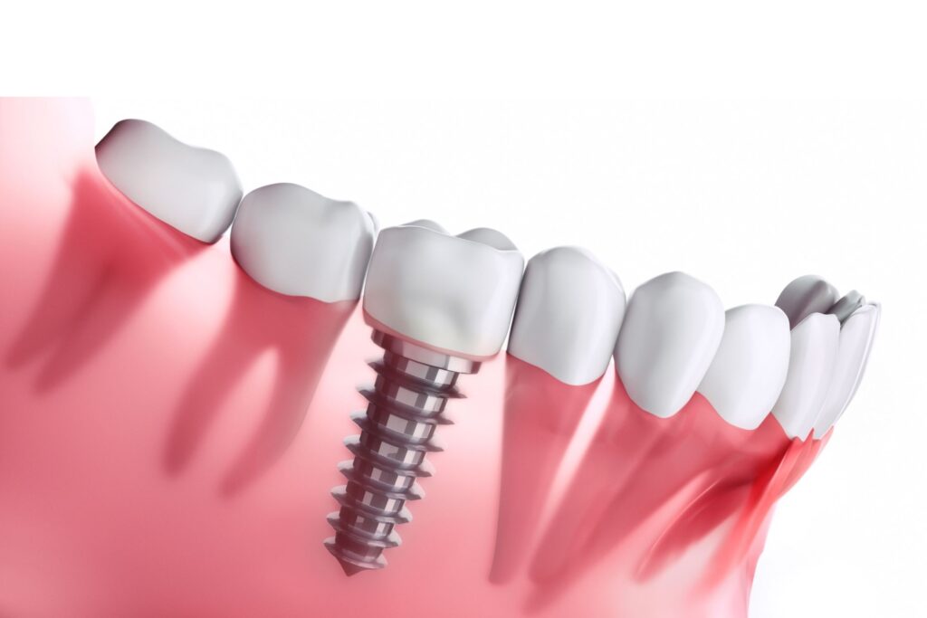 Dental implant – process, lifespan and installation costs