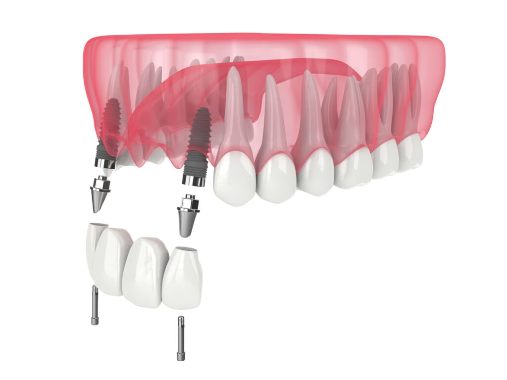 3D-Darstellung des Kiefers mit Zahnschneidezähnen Brücke im Oberkiefer durch Implantate auf weißem Hintergrund unterstützt