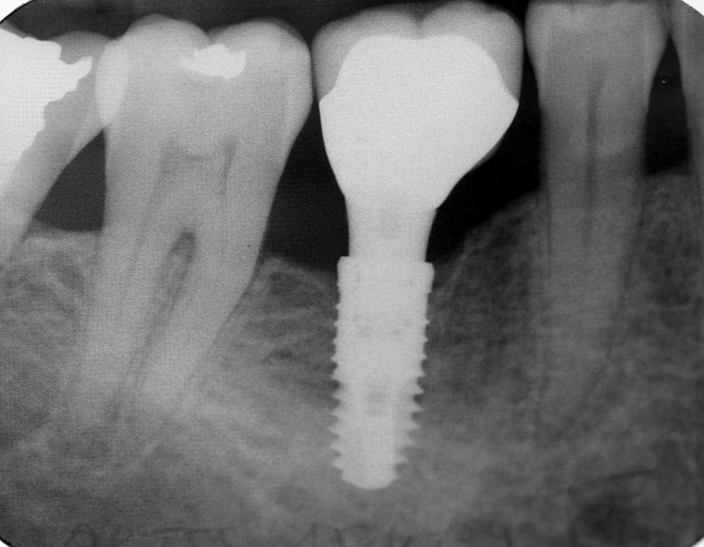 Dental implant radiograph