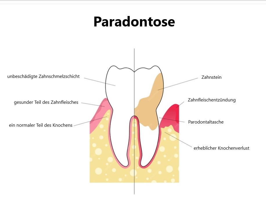 Vergleich eines gesunden Zahns mit einem von Parodontose betroffenen Zahn