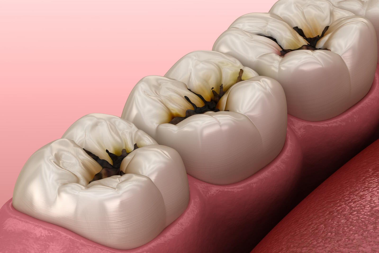 Illustration von Karies und Kavitationen auf Zähnen: Darstellung der Zahnschmelzschädigung und Ausbreitung in das Dentin.