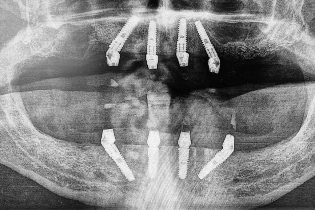 Rendgenski snimak All-on-4 implantata u gornjoj i donjoj vilici, koji prikazuje precizno postavljanje implantata i njihovu stabilnost u obje vilice.