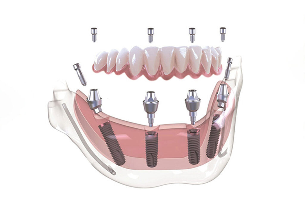 “All-on-4” koncept ugradnje implantata: sve što treba da znate