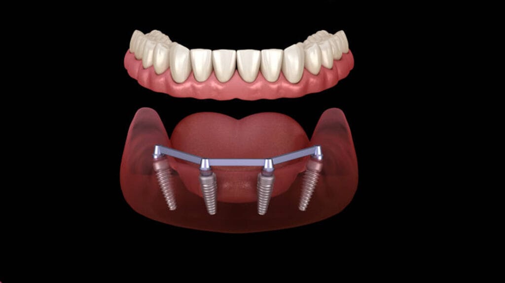 All-on-4 koncept ugradnje implantata, ilustrovani prikaz donje vilice i kako to izgleda ispod postavljenih krunica