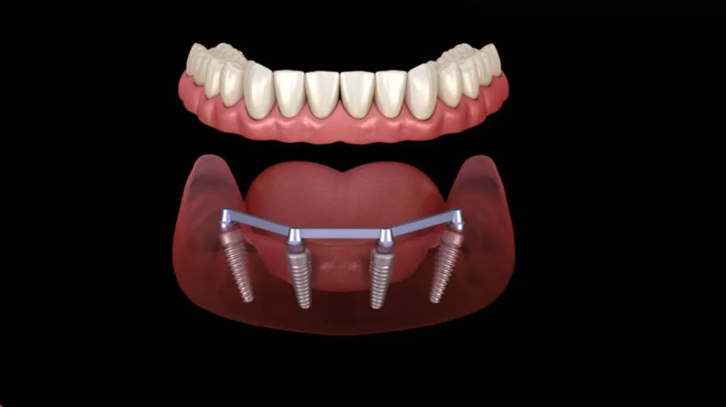 All-on-4 koncept ugradnje implantata, ilustrovani prikaz donje vilice i kako to izgleda ispod postavljenih krunica