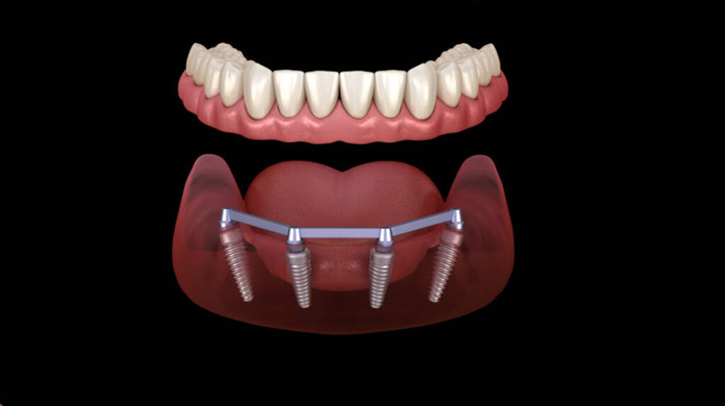 All-on-4-Konzept für Zahnimplantate: Illustrierte Darstellung des Unterkiefers und wie es unter den eingesetzten Kronen aussieht