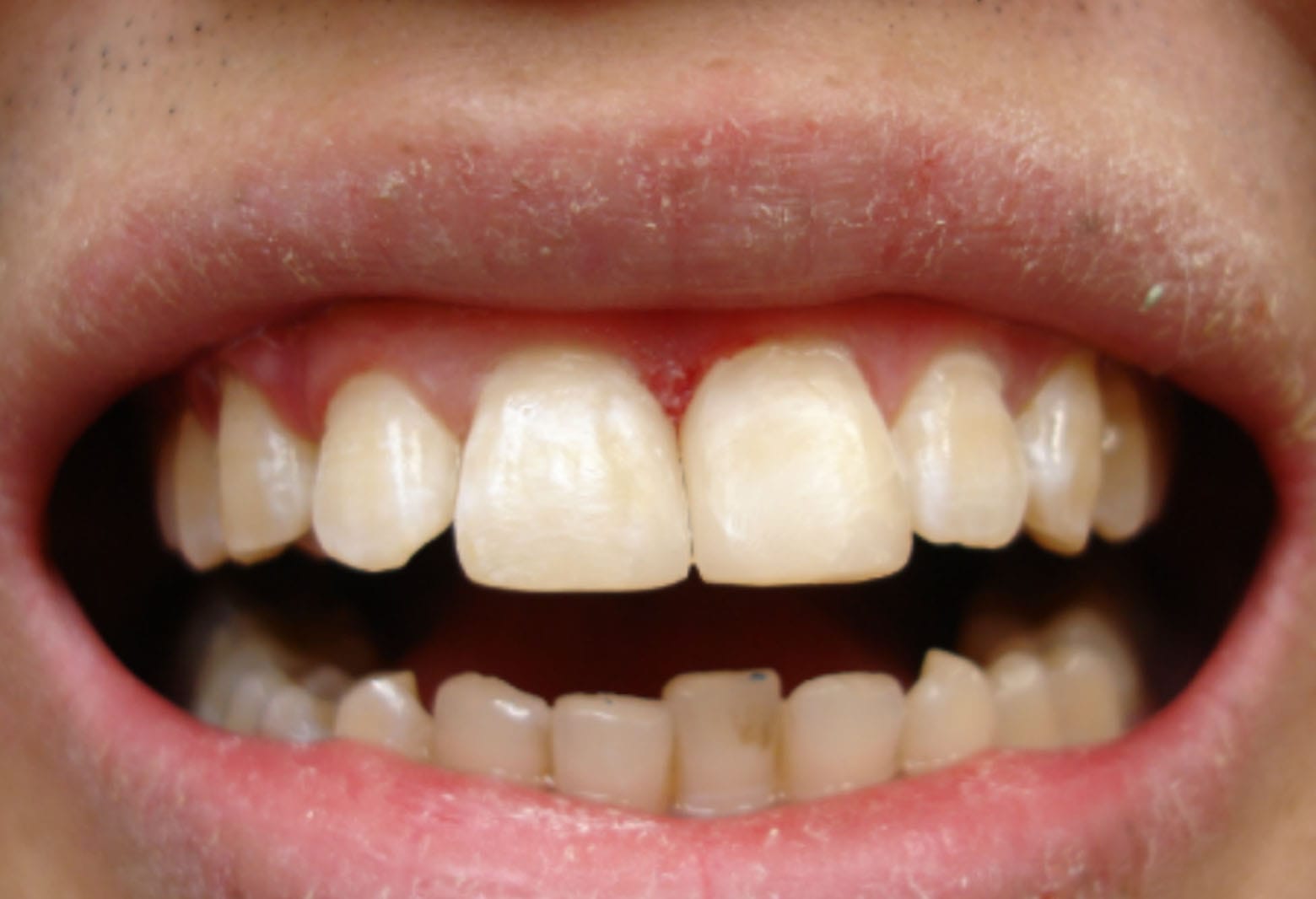 slika zuba nakon stomatološkog zahvata