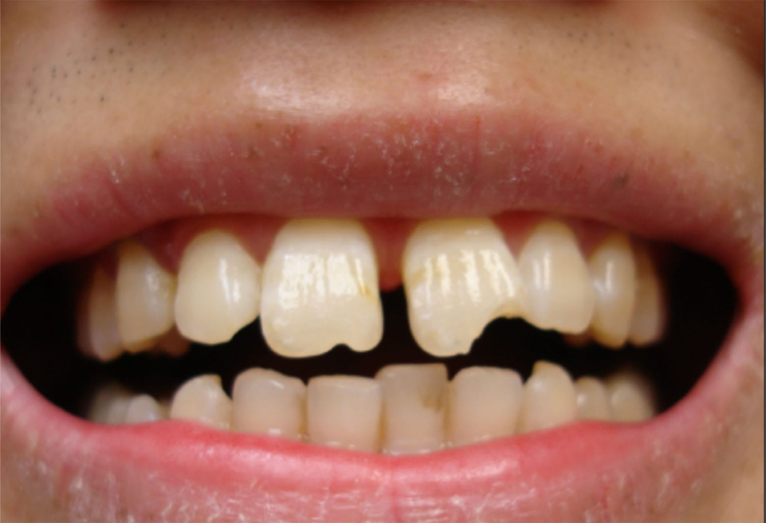 slika zuba prije zahvata